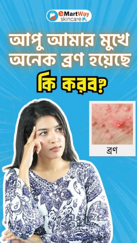 Skincare for Acneprone skin