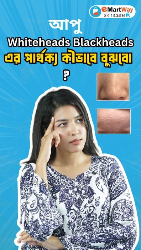 Difference between WHITEHEADS & BLACKHEADS
